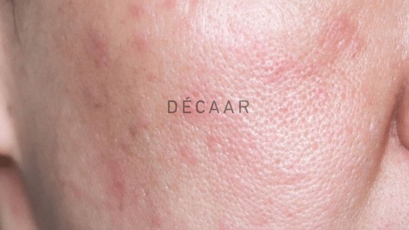 Dị ứng da mặt
